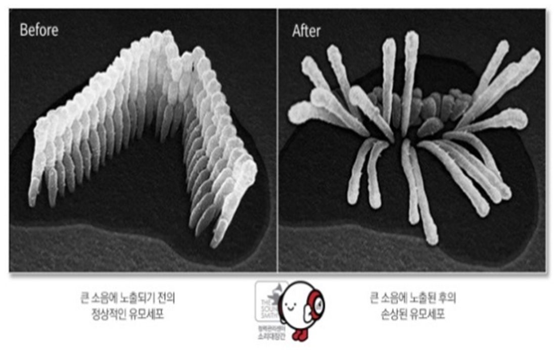 큰 소음 노출 전후의 유모세포 전자현미경 사진