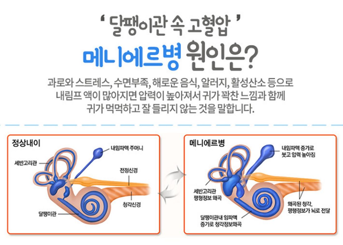 정상 내이와 메니에르병 내이 비교 그림