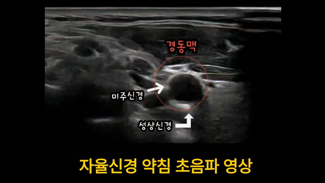 목 앞쪽 초음파 — 경동맥·경정맥 옆 성상신경·미주신경 위치 표시