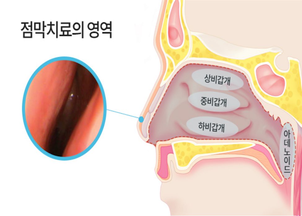 코 점막 치료의 영역 — 상비갑개·중비갑개·하비갑개 해부 구조