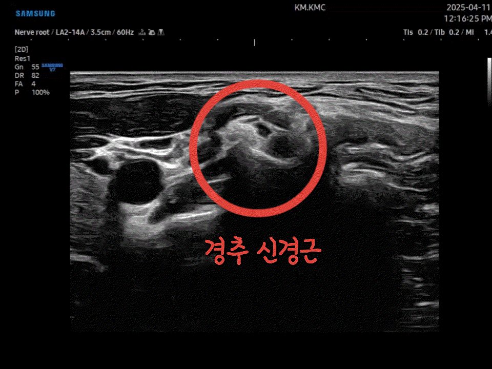 경추 신경근 초음파 화면 — 빨간 원으로 신경근 위치 표시