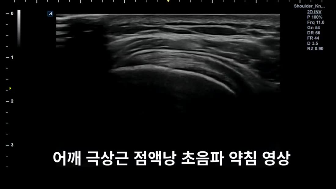 어깨 극상근 아래 점액낭 초음파 약침 화면